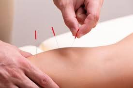 acupuncture for athletes